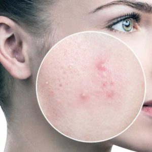Colon Cleaning May Help Acne Sufferers