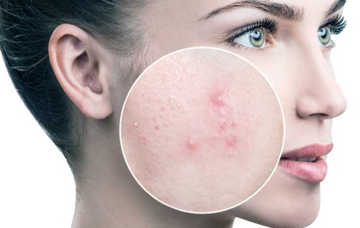 Colon Cleaning May Help Acne Sufferers